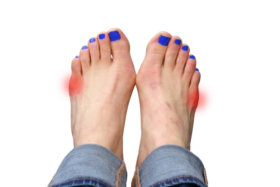 Tailor’s Bunion Treatment: Effective Options to Relieve Pain and Improve Alignment